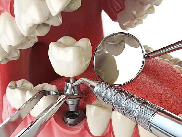 Best Emergency Tooth Extraction in Lake Elsinore, CA